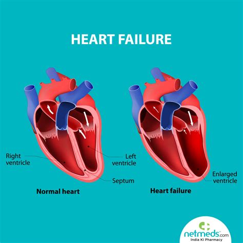 lv disfunction|what does lv dysfunction mean.